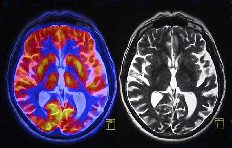 Trauma Exposure May Alter Brain Networks Linked to Learning and Survival